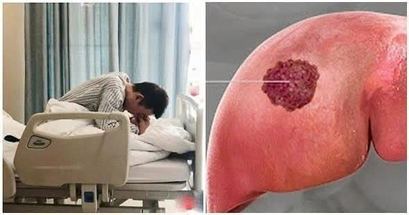 Bệnh nhân quađời sau 60 ngày phát hiện UT g:a:n, BS kh;ẩn cầ’u: Đừng ăn 2 món h:ủ:y d:iệ:t g:a:n nữa